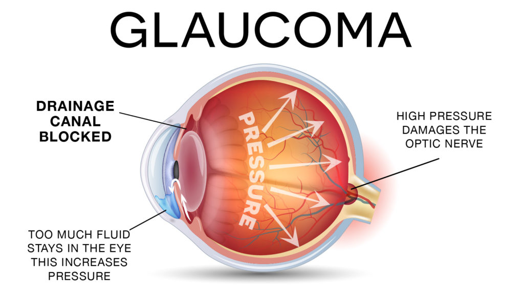 Glaucoma Eye