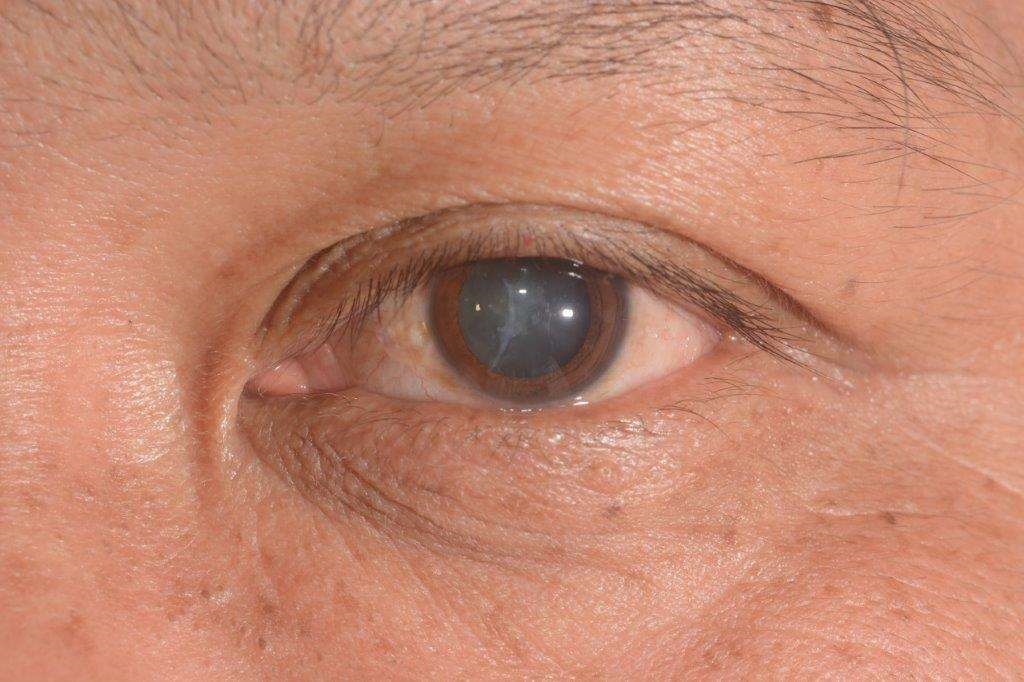 Eye Cataract person