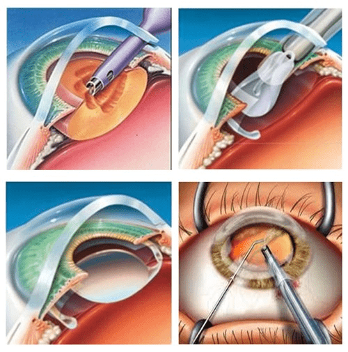 Cataract Surgery In Jaripatka